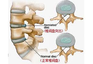 腰椎间盘突出