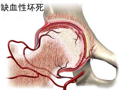 福州股骨头坏死治疗