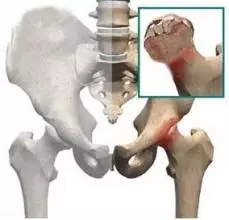 股骨头坏死