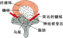 腰椎间盘突出