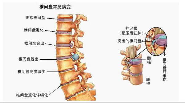 腰椎间盘突出有哪些症状危害