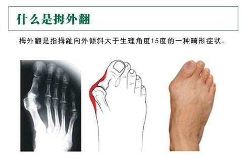 福州大拇指（拇外翻）形成的原因有哪些