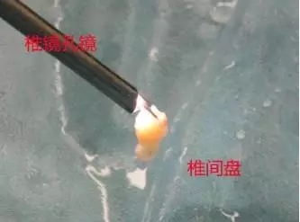 福州看腰椎间盘突出