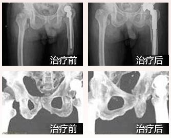 福州治疗腰椎病哪家医院好