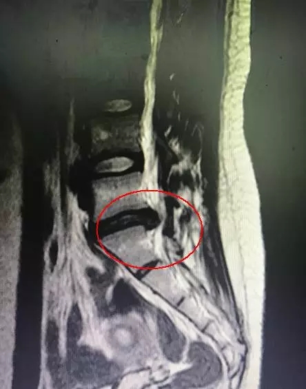 腰椎间盘突出