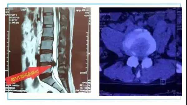 腰椎间盘突出