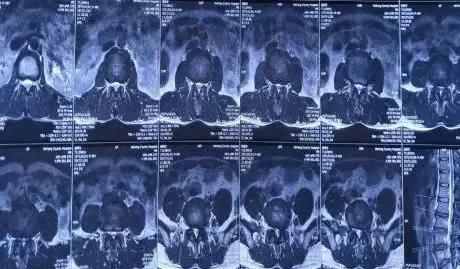 福州治疗腰椎间盘突出临床案例