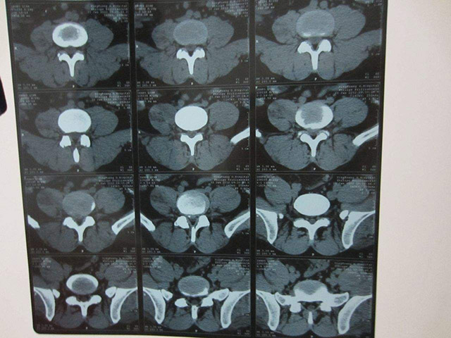 腰椎间盘突出治疗