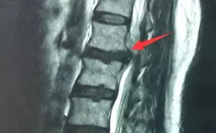 福州腰椎间盘突出医院