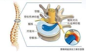 福州治疗腰椎间盘突出哪家医院好