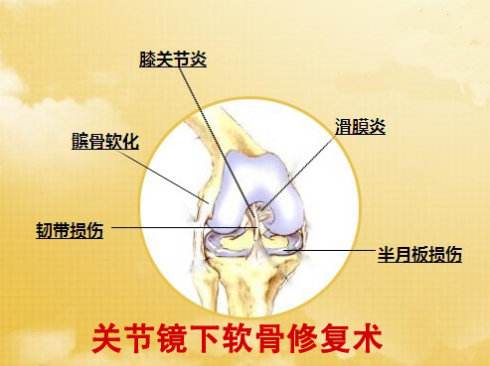 福州关节镜治疗关节炎