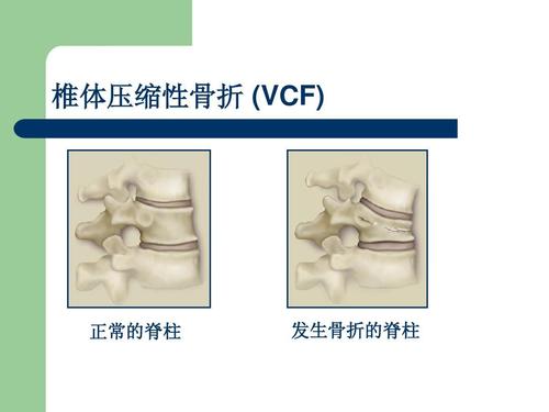 椎体压缩性骨折去福州哪家骨科医院