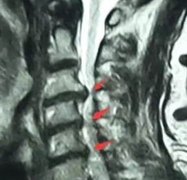 福州治疗腰椎间盘突出哪家医院好